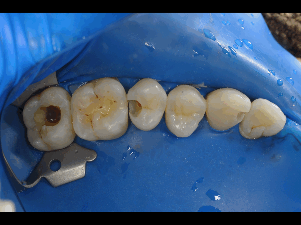 (naoki)セラミックオーバーレイ治療とラバーダムテクニック naoki)セラミックオーバーレイ治療とラバーダムテクニック naoki