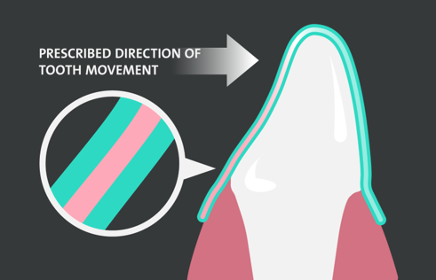 ClearQuartz|Refino Dental Clinic