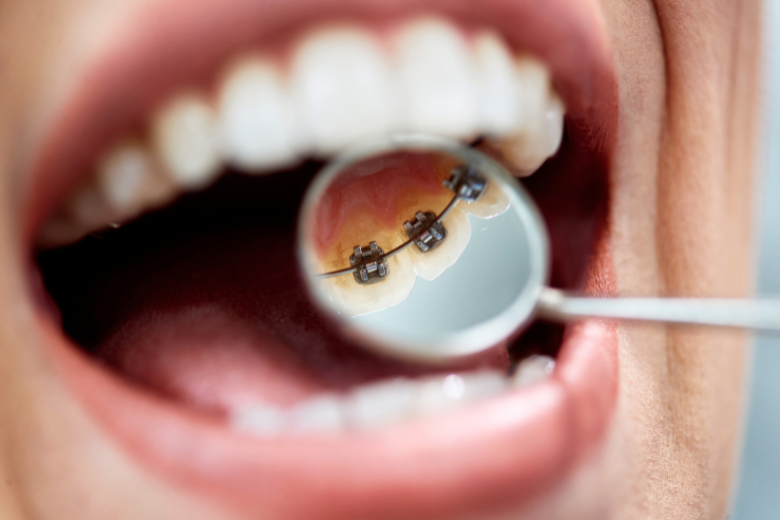 リンガルブラケット|refino dental