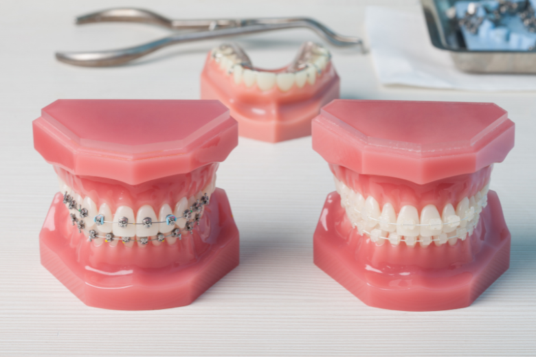 表側矯正|refino dental