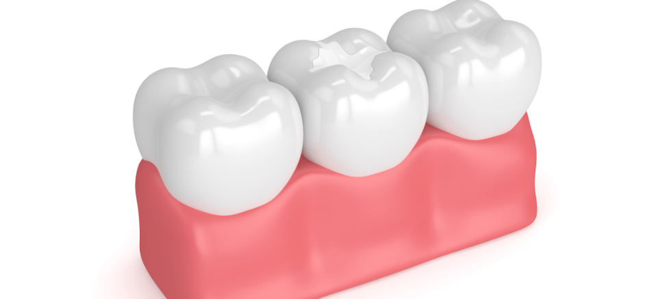 シーラント|refino dental