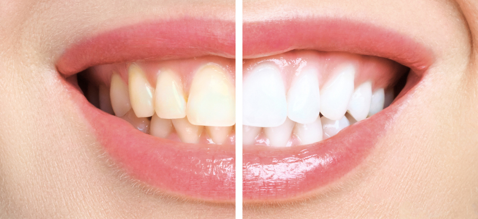 歯質の強化|refino dental