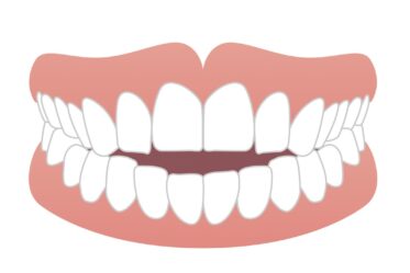 オープンバイト