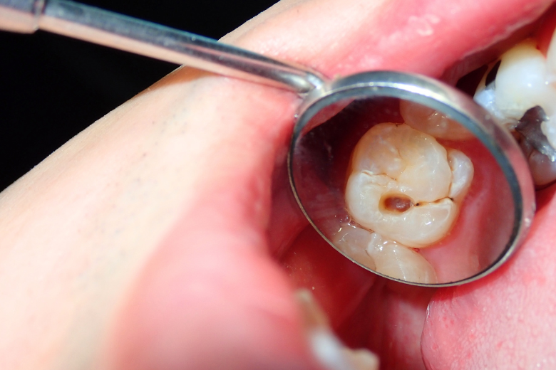 虫歯|refino dental