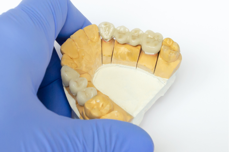 ブリッジ|refino dental
