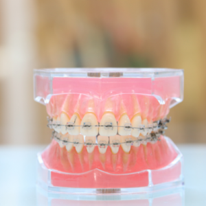矯正装置|refino dental