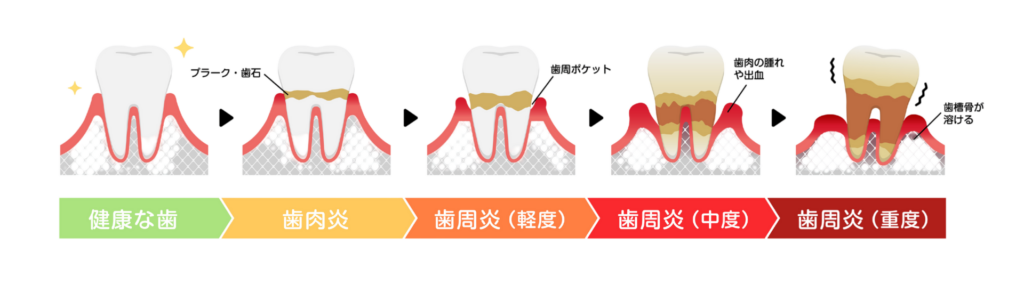 歯周病の進行|refino dental