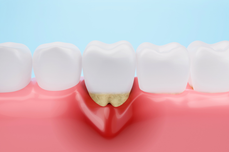 歯茎再生治療|refino dental
