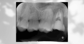 精密根管治療｜Refino Dental Clinic