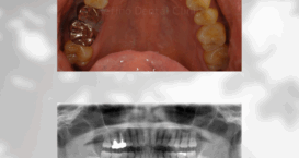 インプラント｜Refino Dental Clinic