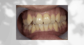 インビザライン｜Refino Dental Clinic