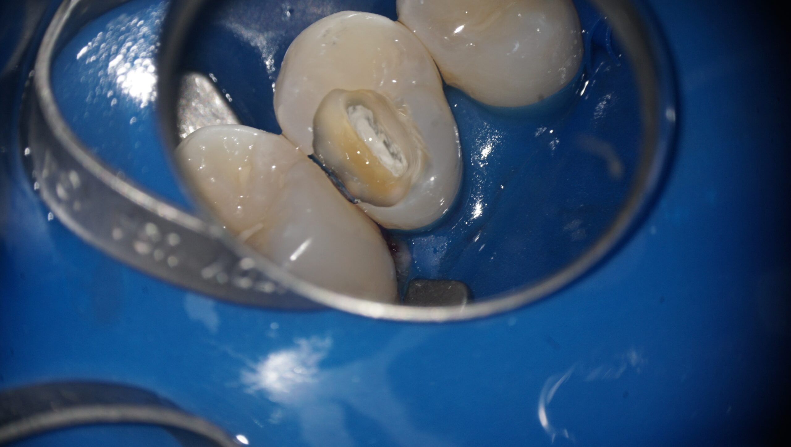 失敗しない歯髄保存療法 : 抜髄する前にもう一度歯髄診断をしよう 失敗しない歯髄保存療法: 抜髄する前にもう一度歯髄診断をしよう