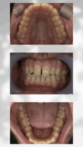 クリアコレクトBefore｜Refino Dental Clinic