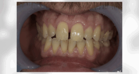クリアコレクトBefore｜Refino Dental Clinic