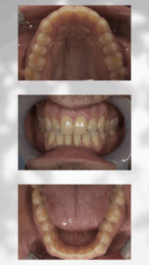 クリアコレクトAfter｜Refino Dental Clinic