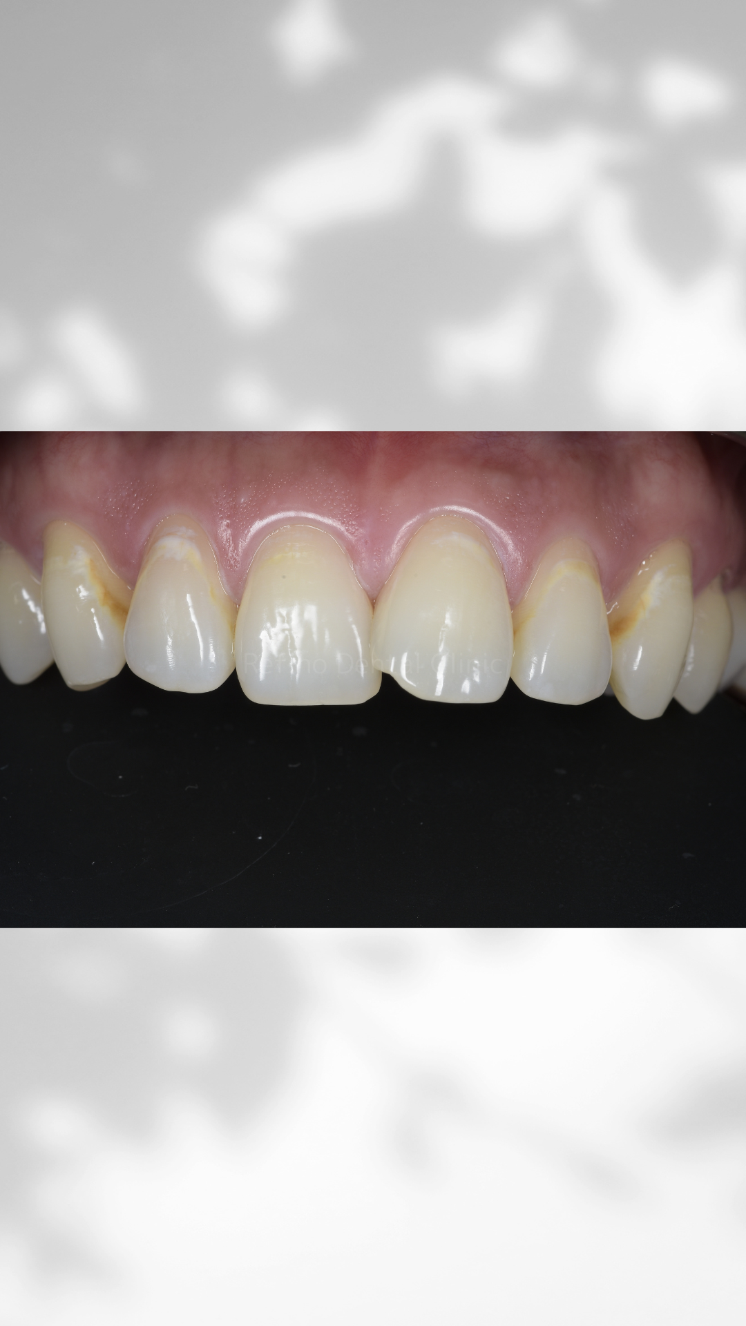 ダイレクトボンディングBefore|Refino Dental Clinic