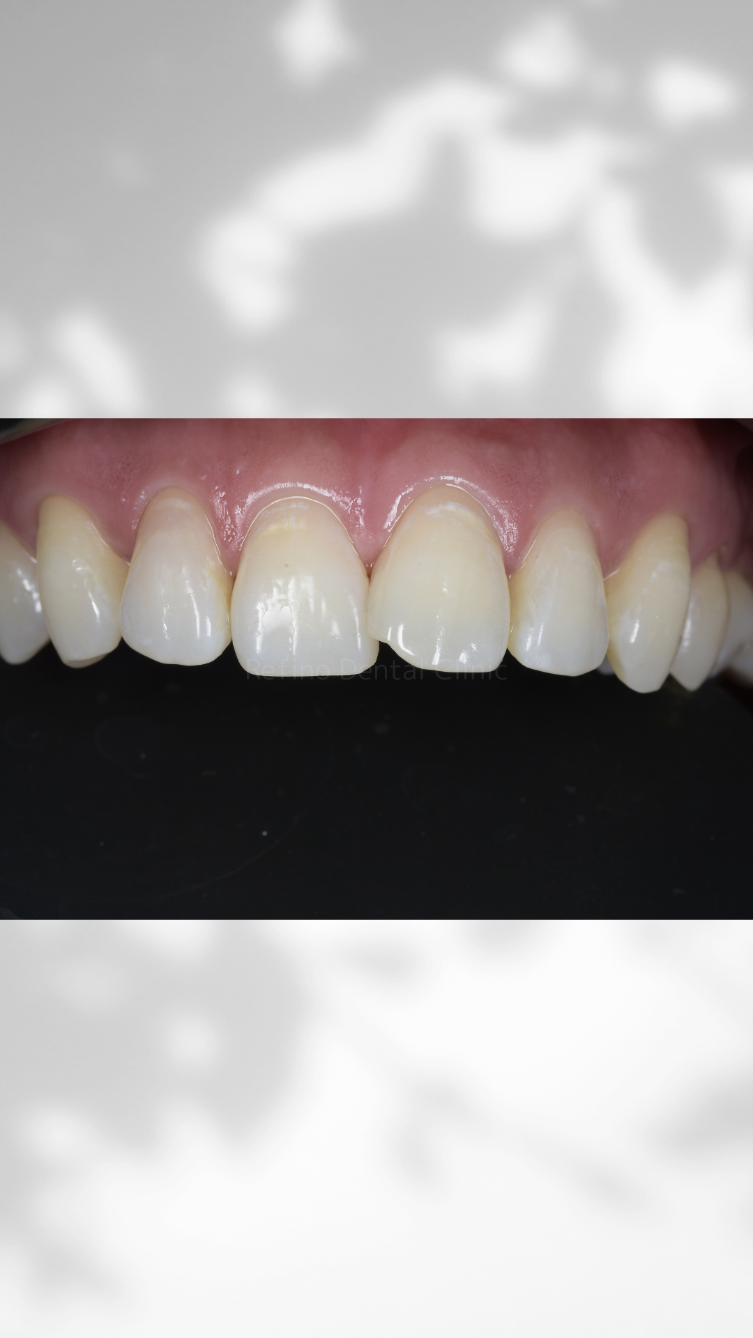 ダイレクトボンディングAfter|Refino Dental Clinic