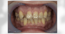 マウスピース矯正　クリアコレクト