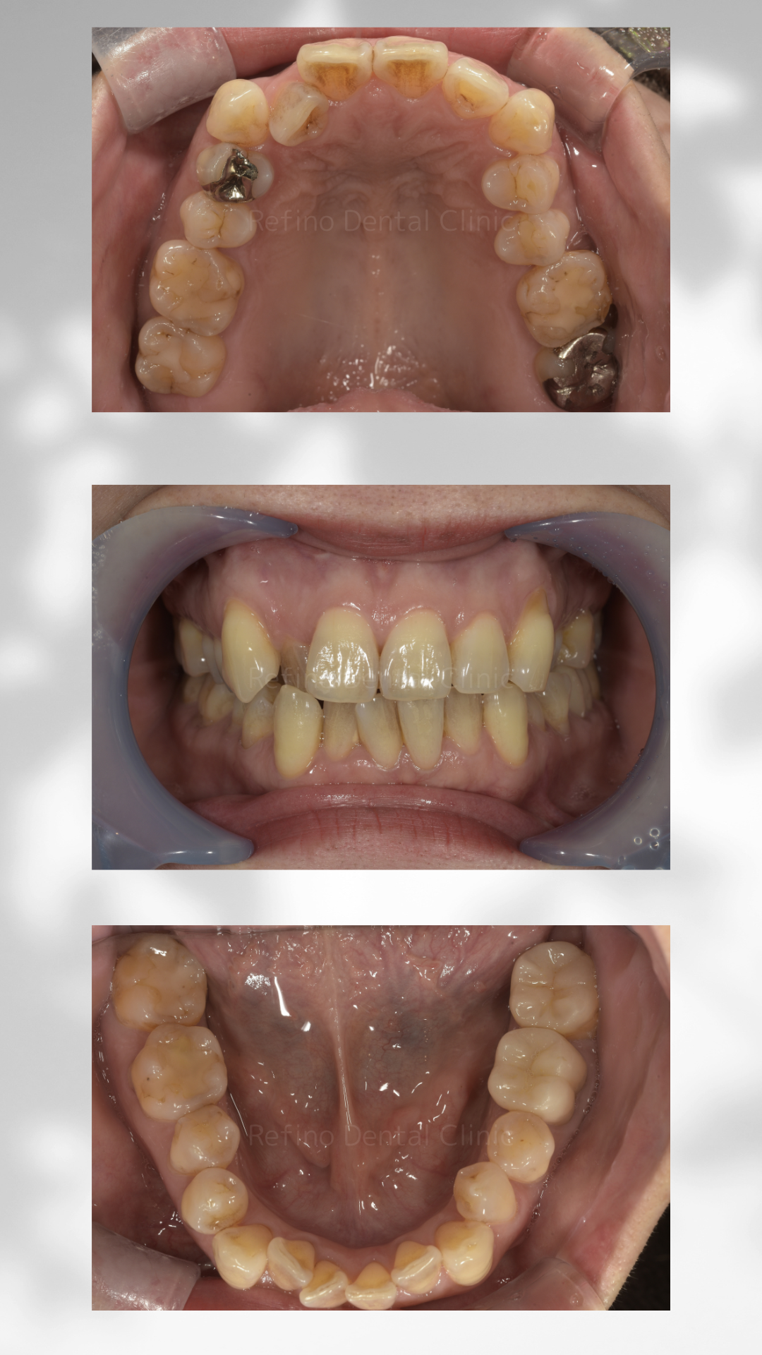 マウスピース矯正 クリアコレクト