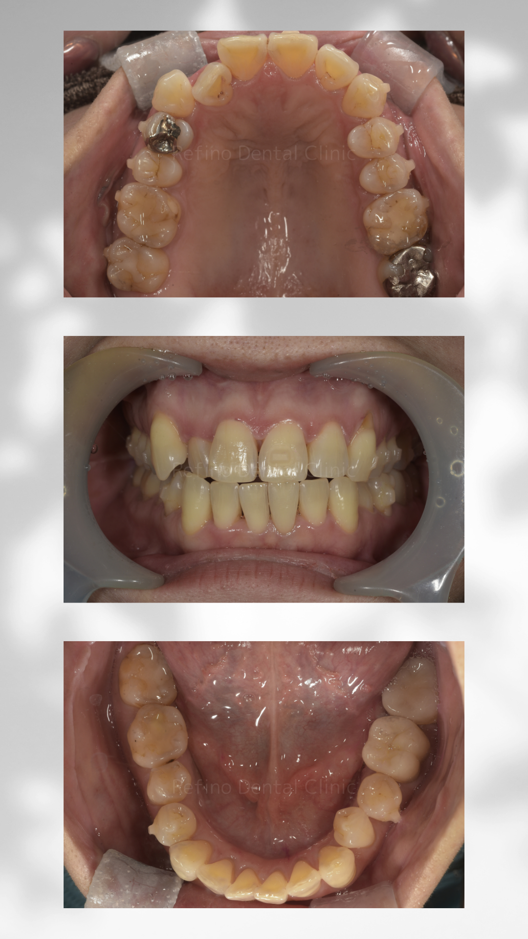 マウスピース矯正 クリアコレクト