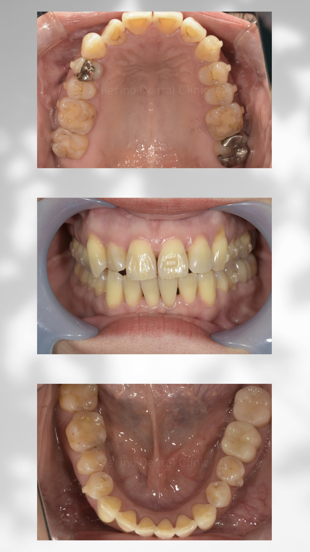 マウスピース矯正