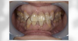 マウスピース矯正　抜歯