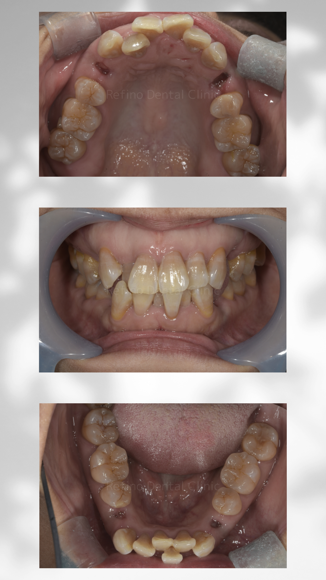 マウスピース矯正　抜歯