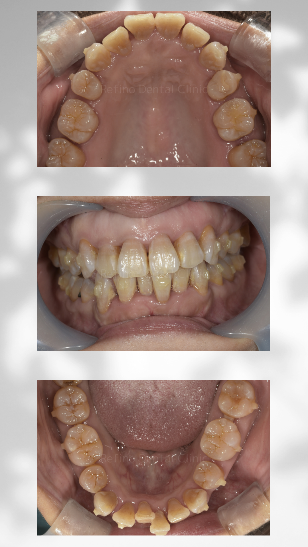 マウスピース矯正　抜歯