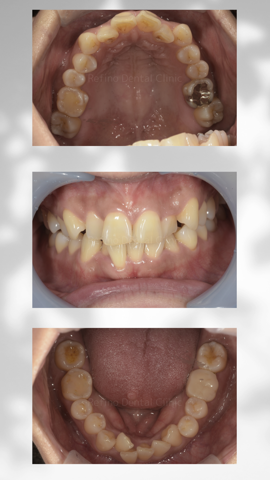 マウスピース矯正　ガタガタ歯並び