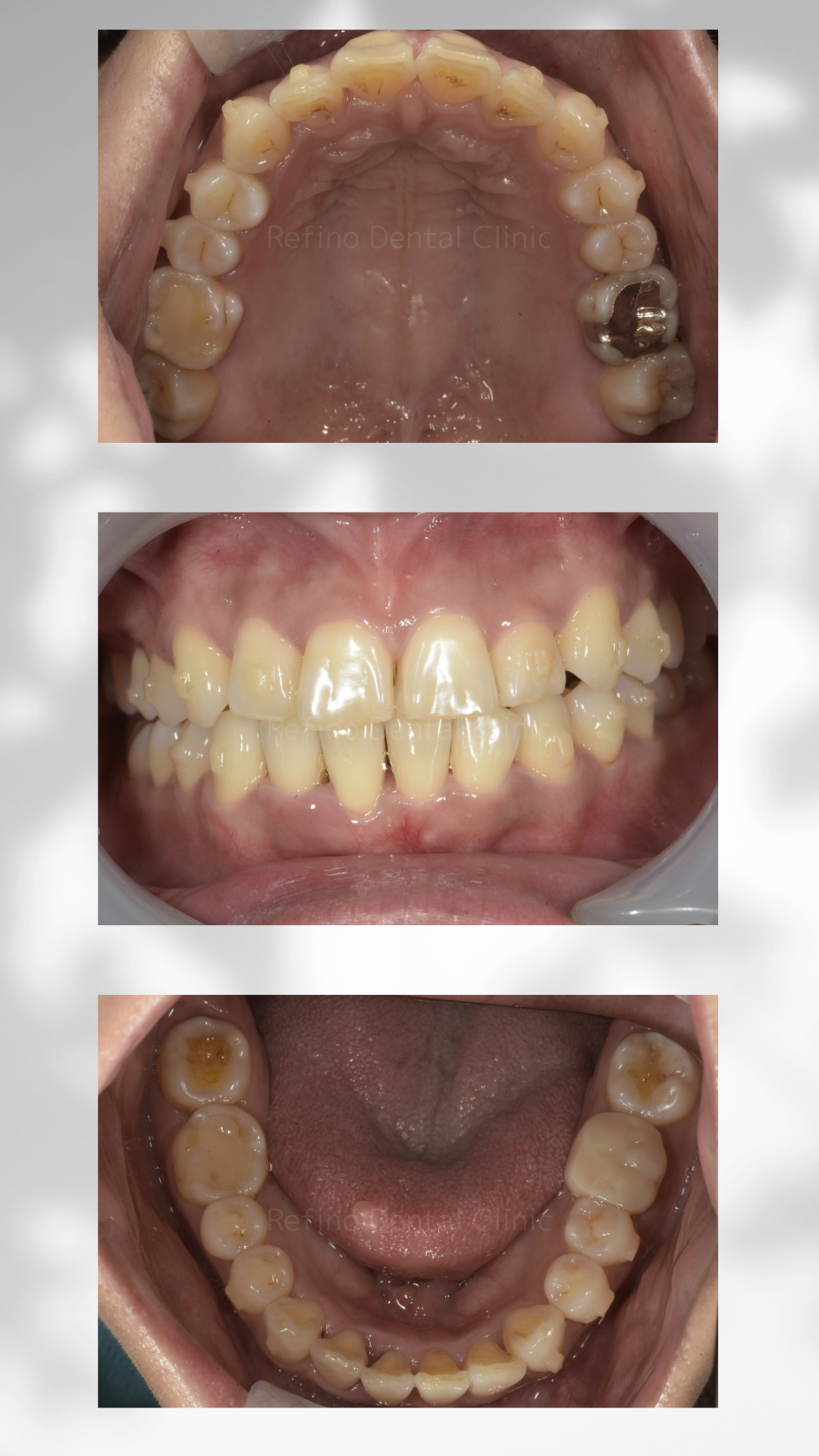 マウスピース矯正　ガタガタ歯並び