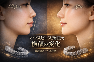 マウスピース矯正で横顔の変化